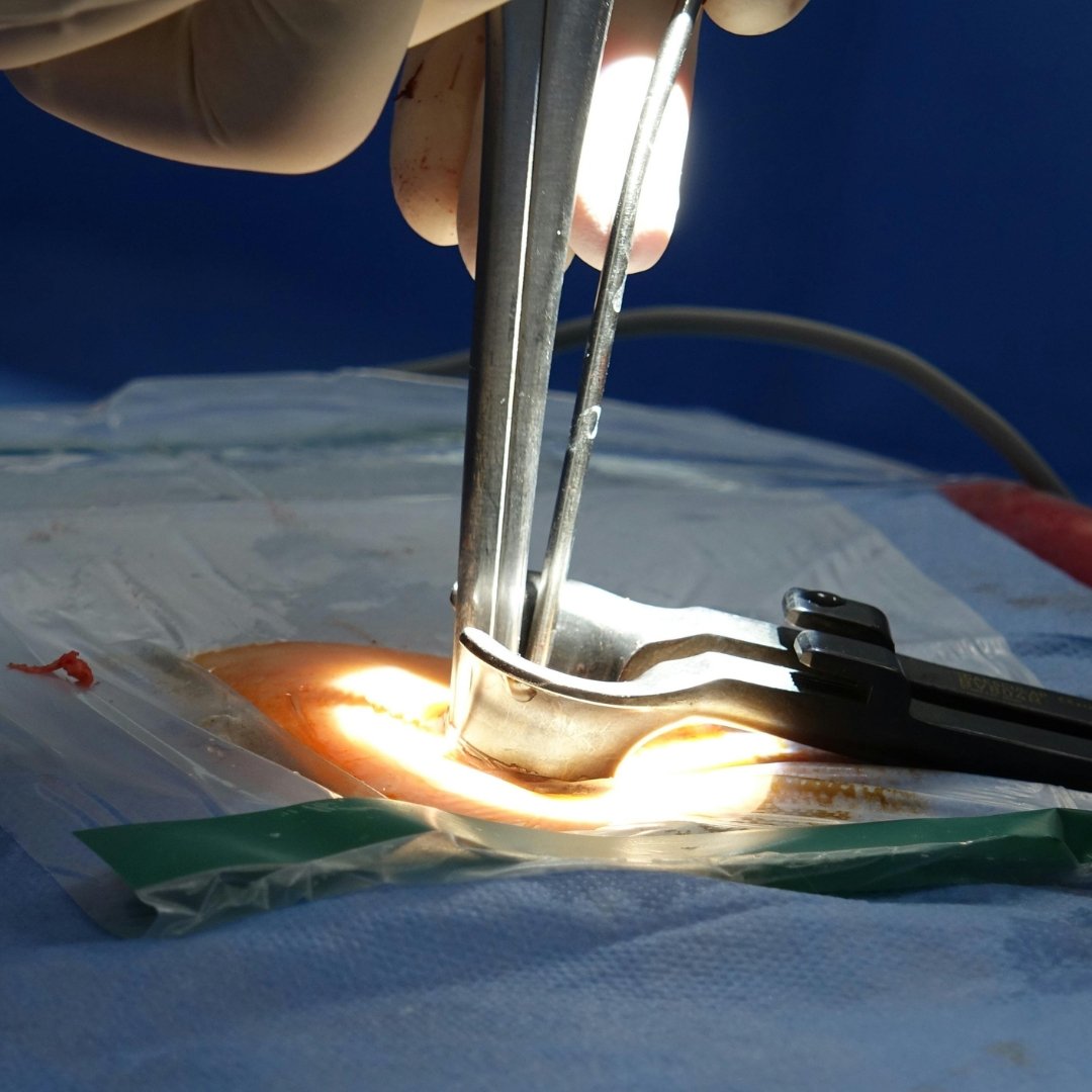 Лямінопластика