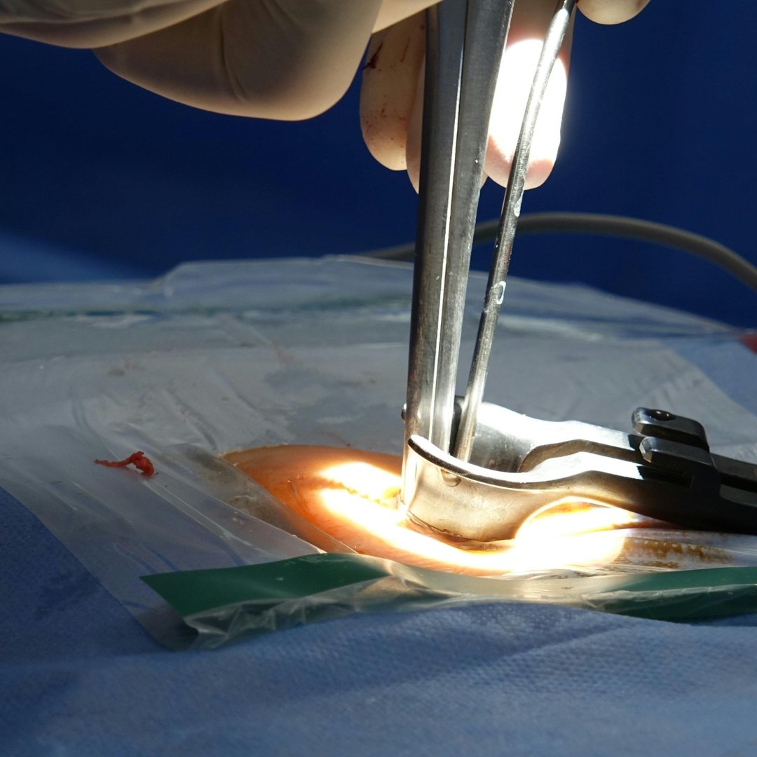 Мікродискектомія