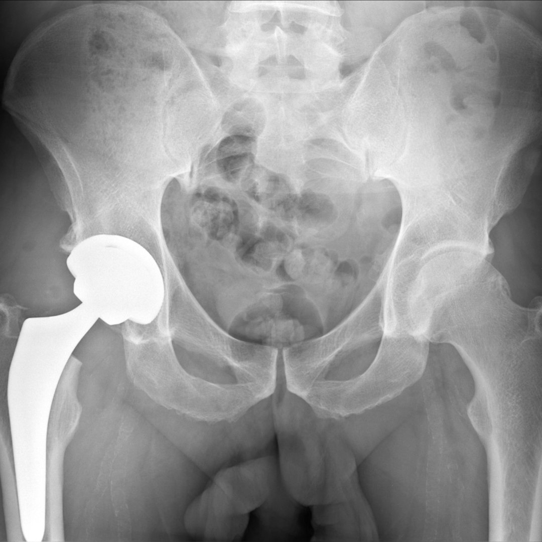 Коксартроз кульшового суглоба